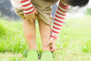 Child scratching mosquito bites on their leg, showing why mosquito control science is important for family safety